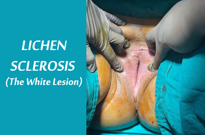 LICHEN SCLEROSIS or The White Lesion